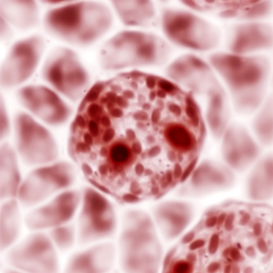 Microscopic view of leukemia cells