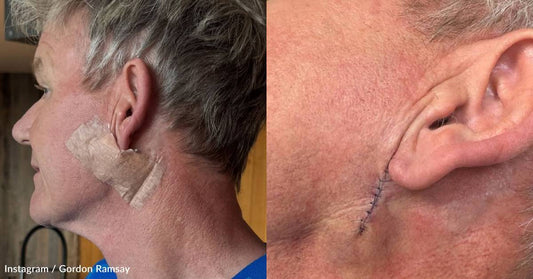 Gordon Ramsay Encourages Sunscreen Use After Skin Cancer Diagnosis